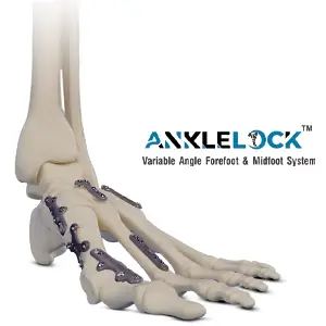 Anklelock — Ankle Locking Plate System