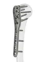 Orthopedic Trauma Implants — Locking Plates and Screws by Siora Surgicals