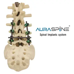 Auraspine — Spinal Fixation System