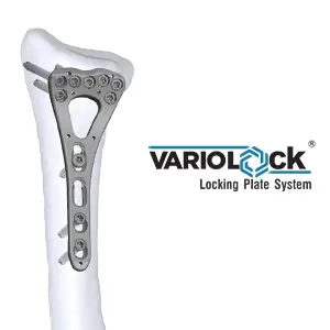 Variolock — Variable Angle Locking Plate System