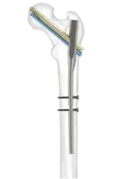 Intramedullary Interlocking Nails for Long Bone Fracture Fixation by Siora Surgicals