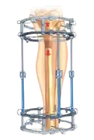 External Fixation System for Complex Orthopedic Trauma by Siora Surgicals