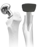 Bipolar Hip and Radial Head Prosthesis by Siora Surgicals