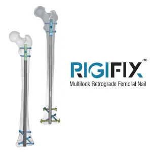 Rigifix — Rigid Fixation Implant System