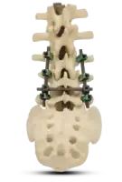Spine Implants — Pedicle Screw and Rod Systems by Siora Surgicals