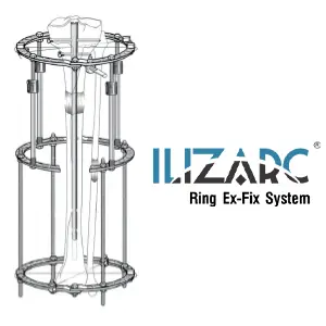 Ilizarc — External Fixation System