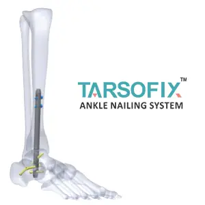 Tarsofix — Tarsal Fixation Nail System